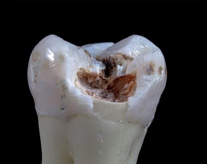 Chipped or Broken Tooth? Here’s What to Do Immediately