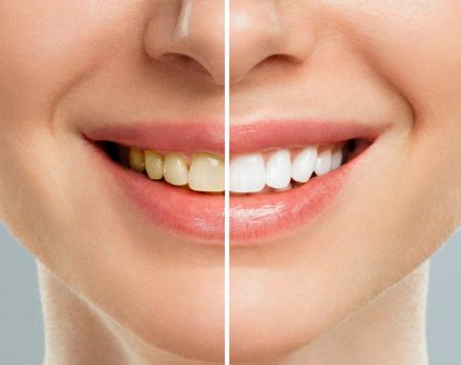 What Is the Best Effective Teeth Whitening?