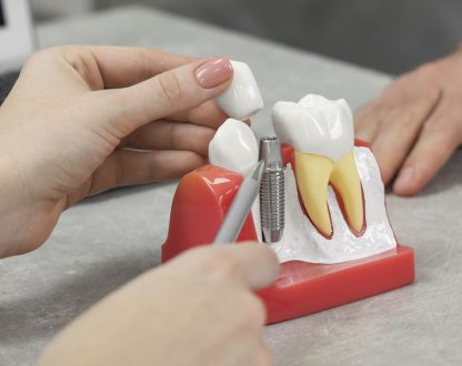 dental implants in Kernersville